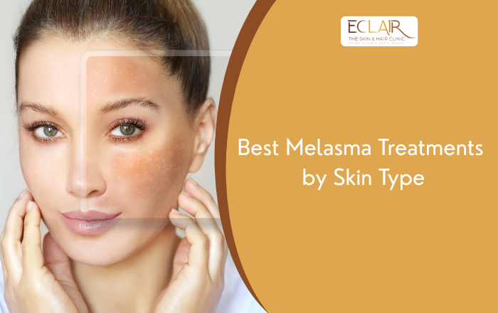 Melasma Treatment Options: What Works Best for Your Skin Type?