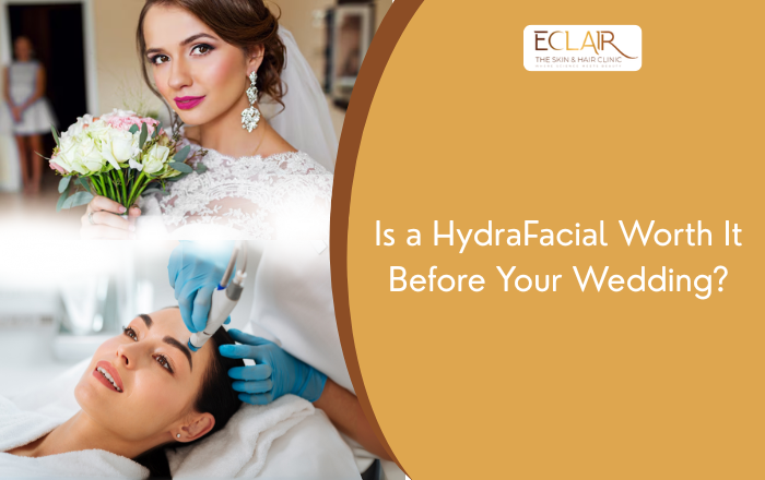 HydraFacial Before Wedding: Is It Worth the Hype?