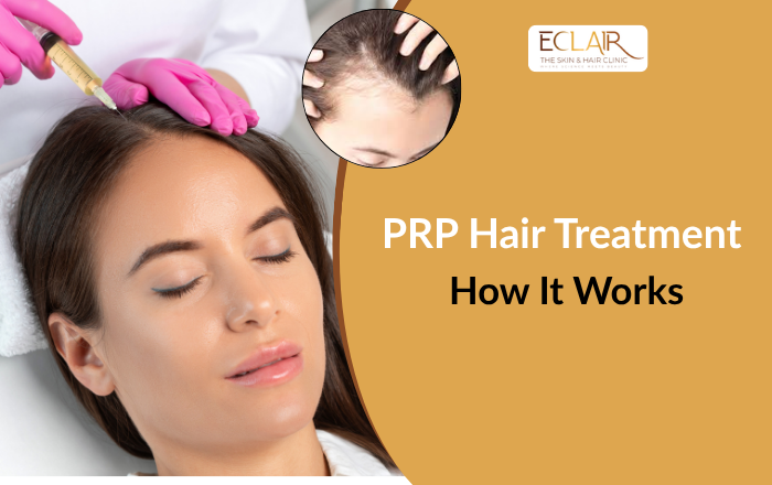What Is PRP Hair Treatment and How Does It Work?