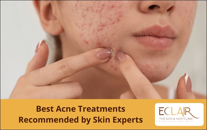 Best Acne Treatment