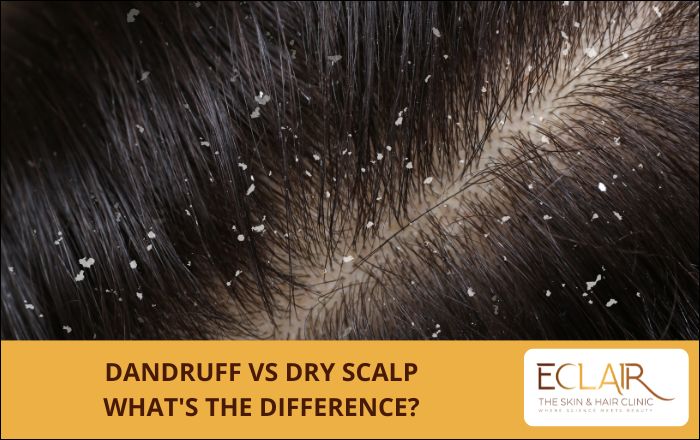 Dandruff vs Dry Scalp What's the Difference