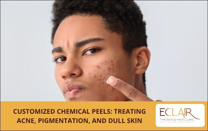 Customized Chemical Peels Treating Acne, Pigmentation, and Dull Skin